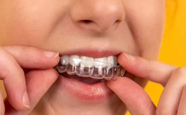 invisalign